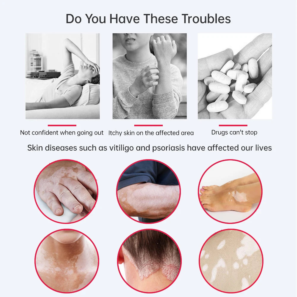 Skin Phototherapy Treatment Lamp