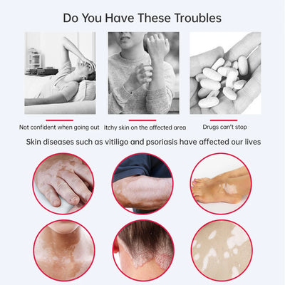 Skin Phototherapy Treatment Lamp