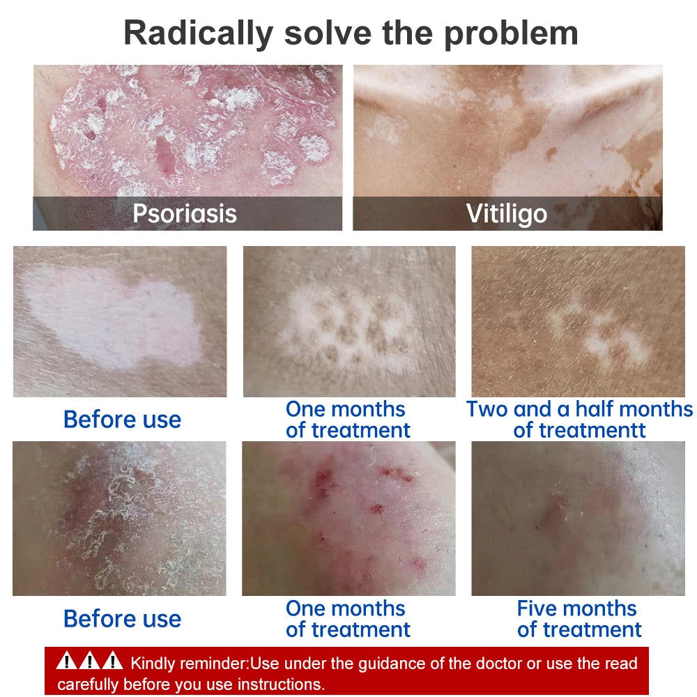 Skin Phototherapy Treatment Lamp