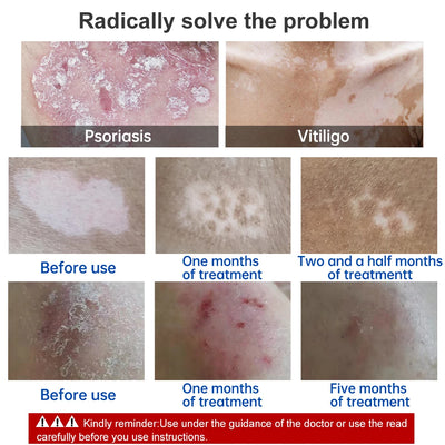 Skin Phototherapy Treatment Lamp